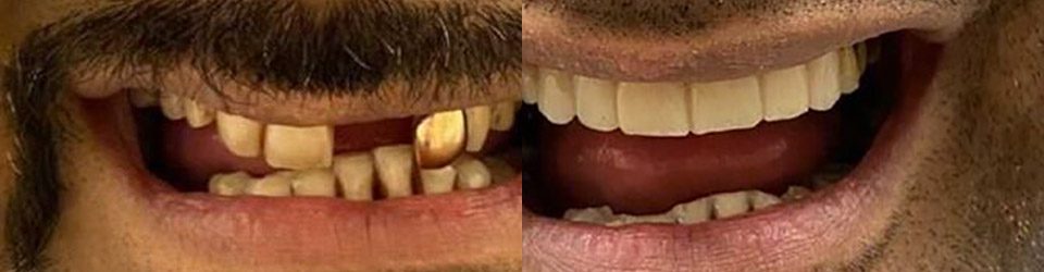 Before and after dental implant transformation