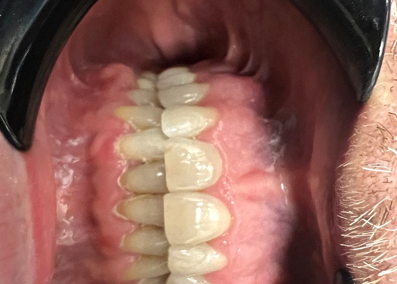 Patient after clear aligner treatment - front view showing improved alignment