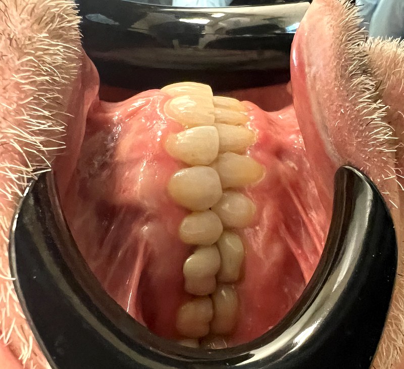 Patient after aligners - side view showing bite improvement