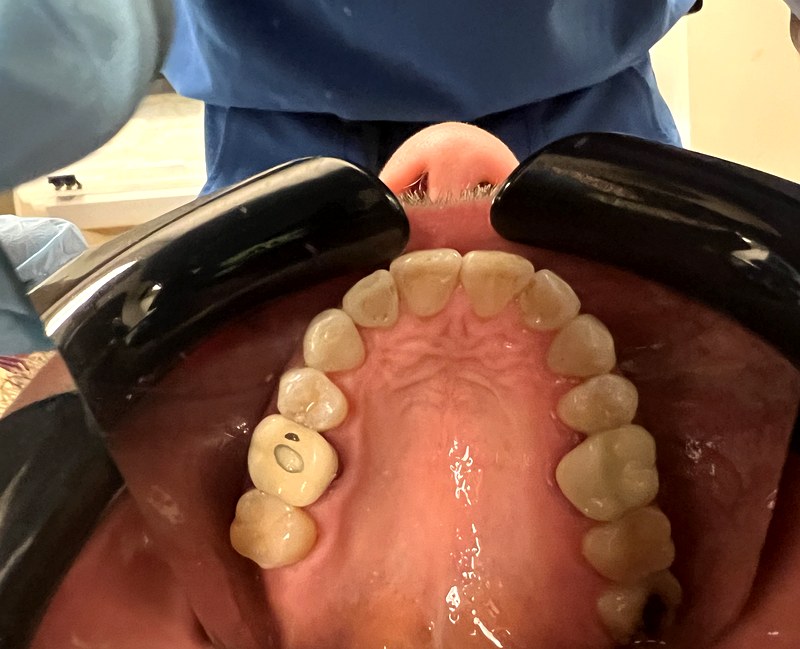 Patient upper arch after aligner treatment showing symmetrical alignment