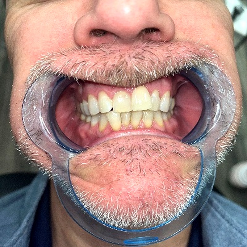 Patient before clear aligner treatment - front view