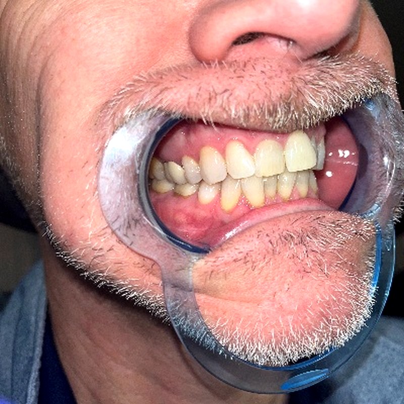 Patient before aligners - side view