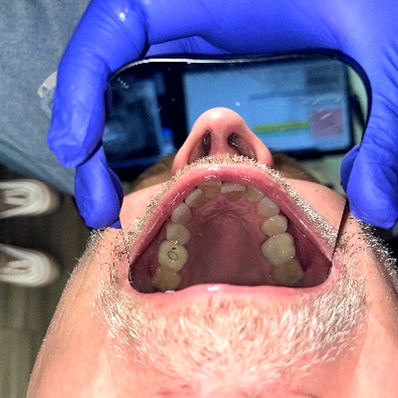 Patient upper arch before aligner treatment